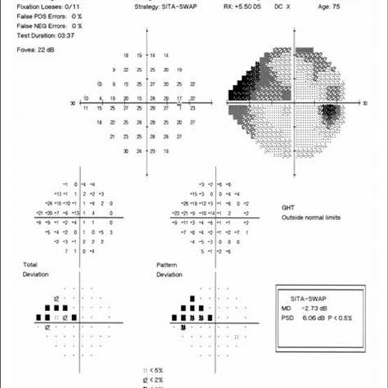 visual-fields